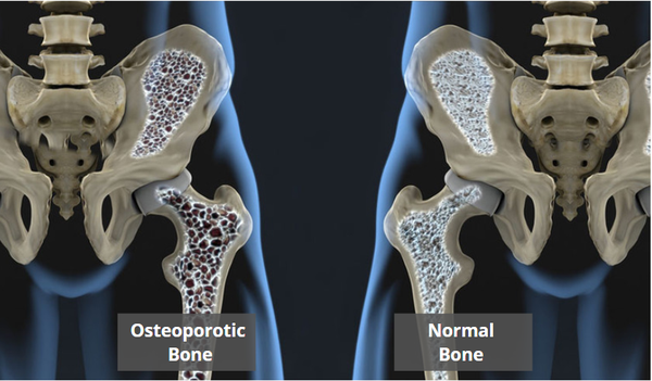 Bone Mineral Density Lifescan Imaging Services